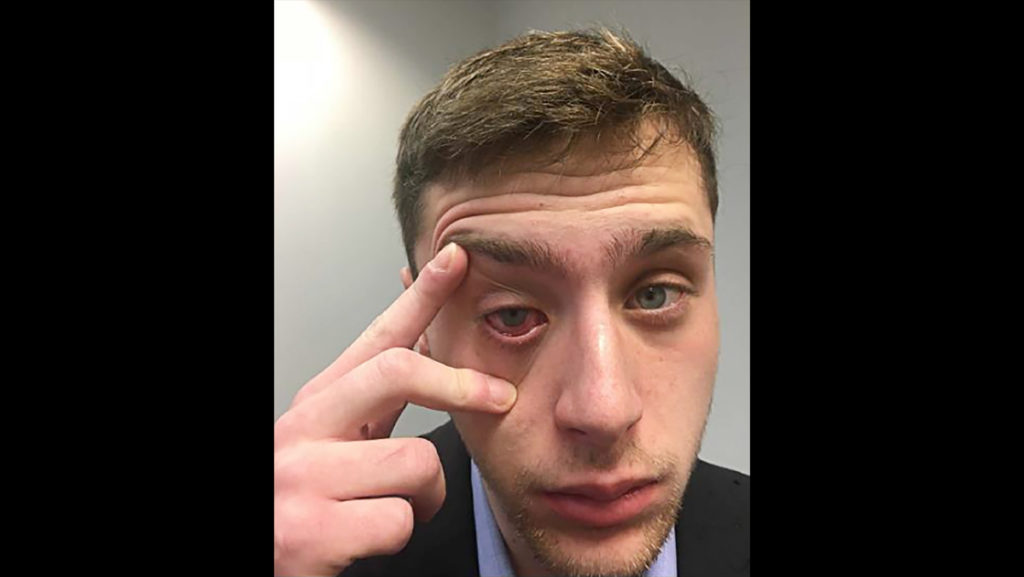 According to court documents, Ithaca police officer Jacob Allard allegedly sprayed Goldstein with pepper spray, causing injuries to both of his eyes and permanent damage to his right eye. 